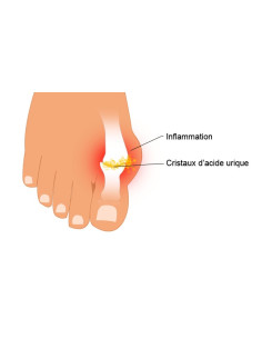 Traitement naturel complet de la crise de goutte